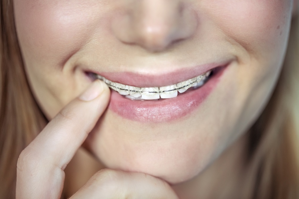 Urgencia dental: problemas con los brackets metálicos