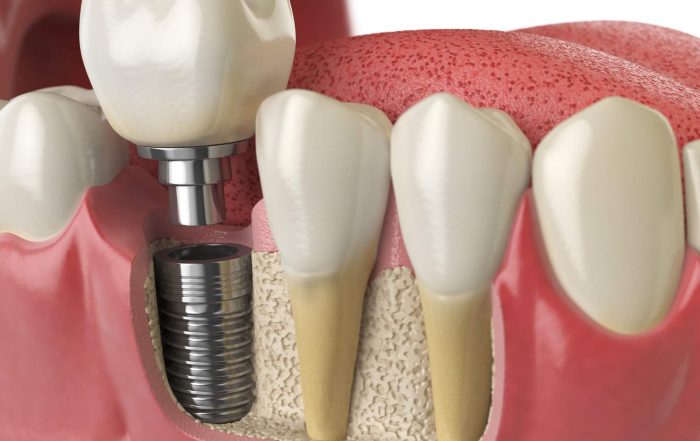 preguntas frecuentes sobre implantes dentales